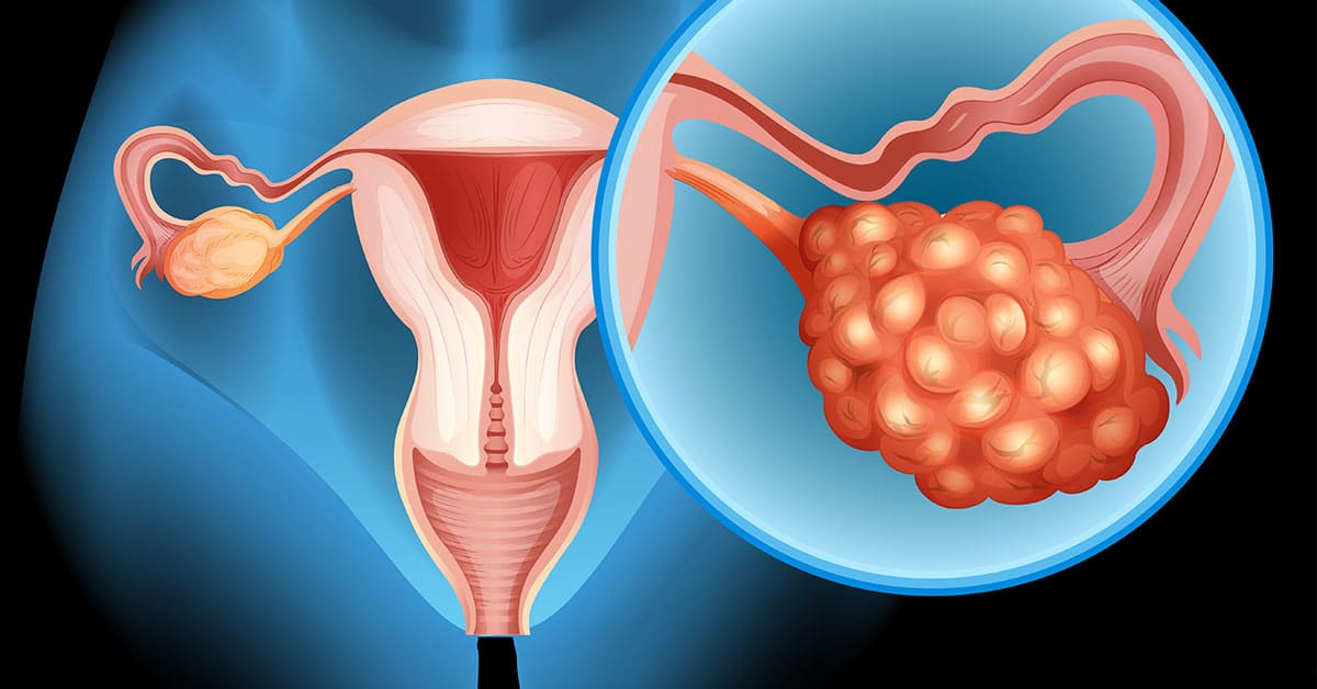 Ilustração médica do útero e dos ovários, com destaque ampliado para um ovário com múltiplos cistos